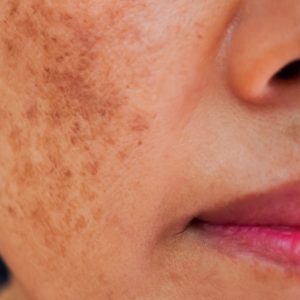 melasma